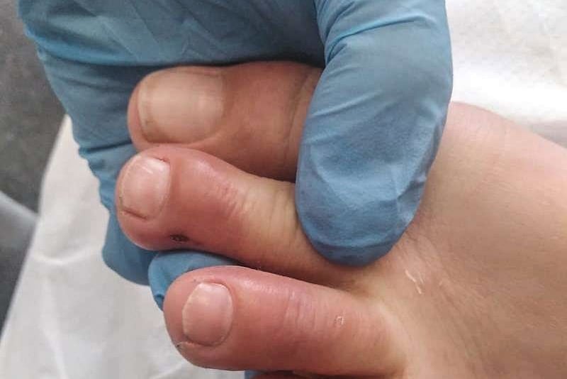 "Dedos covid", una afección que padecen pacientes que tuvieron covid-19.