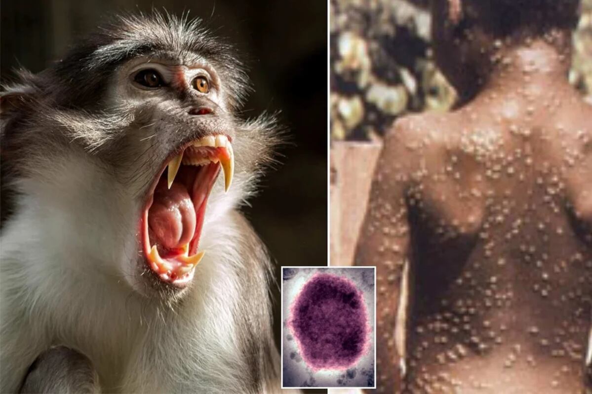 La viruela del mono ya se conocía en Africa, pero se detectaron casos en Europa.