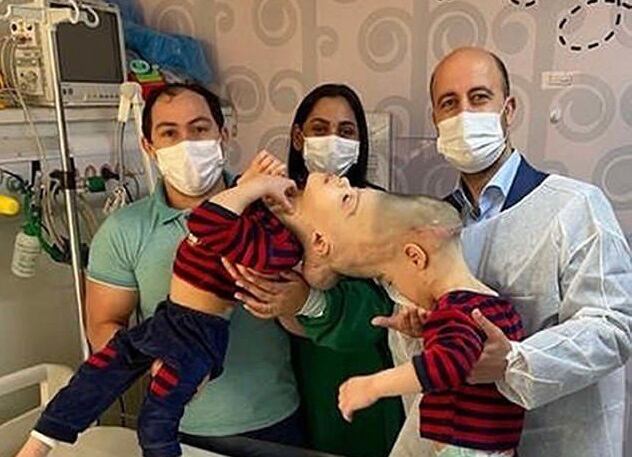 Arthur y Bernardo Lima nacieron en 2018 como gemelos craneópagos, una condición extremadamente rara por la que los hermanos están fusionados en el cráneo. Foto: Instituto Estatal del cerebro Paulo Niemeyer