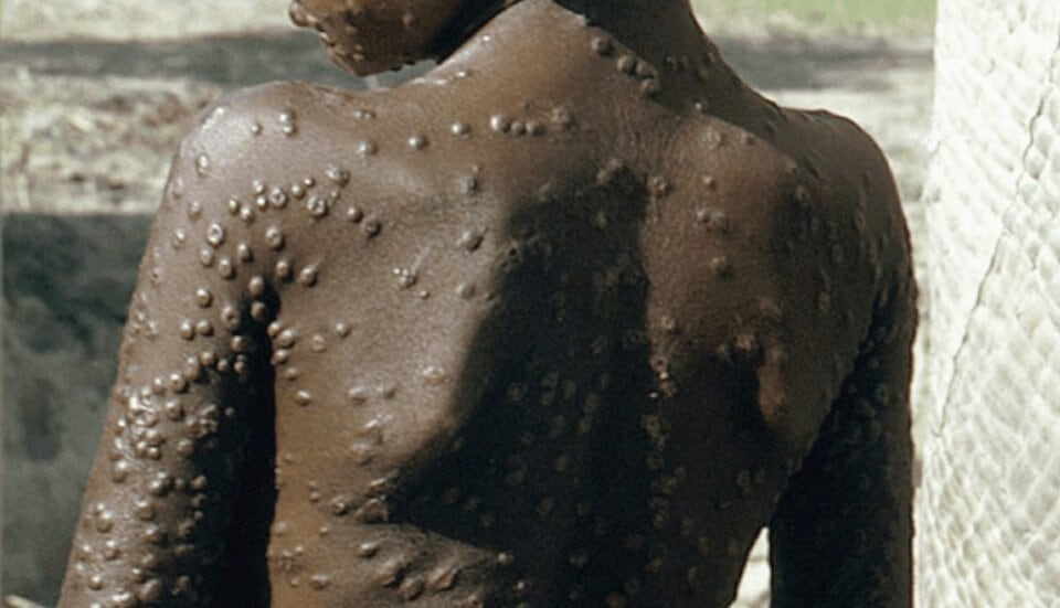 Viruela del Mono en Argentina. Imagen: Página 12.