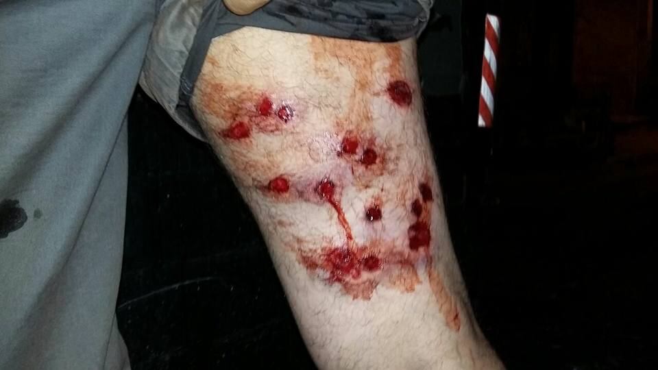 Las heridas de los vecinos que fueron reprimidos con balas de goma de la Policía de la Ciudad.