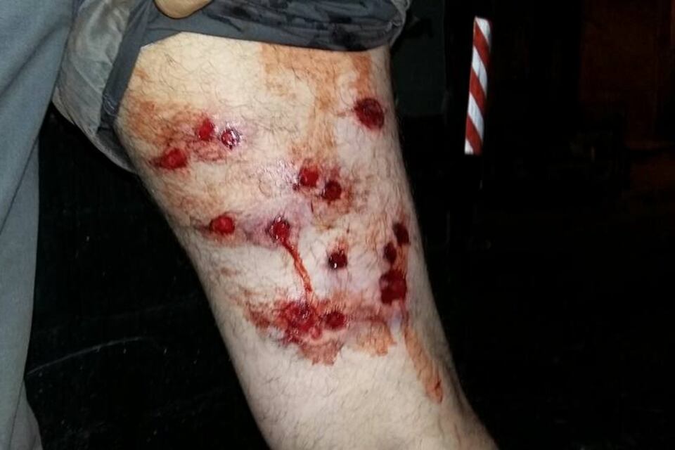 Las heridas de los vecinos que fueron reprimidos con balas de goma de la Policía de la Ciudad.