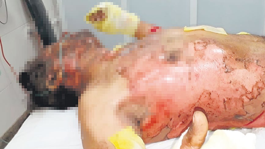 Héctor Reyes Corvalán tiene el 45 por ciento del cuerpo quemado y su vida corre peligro.