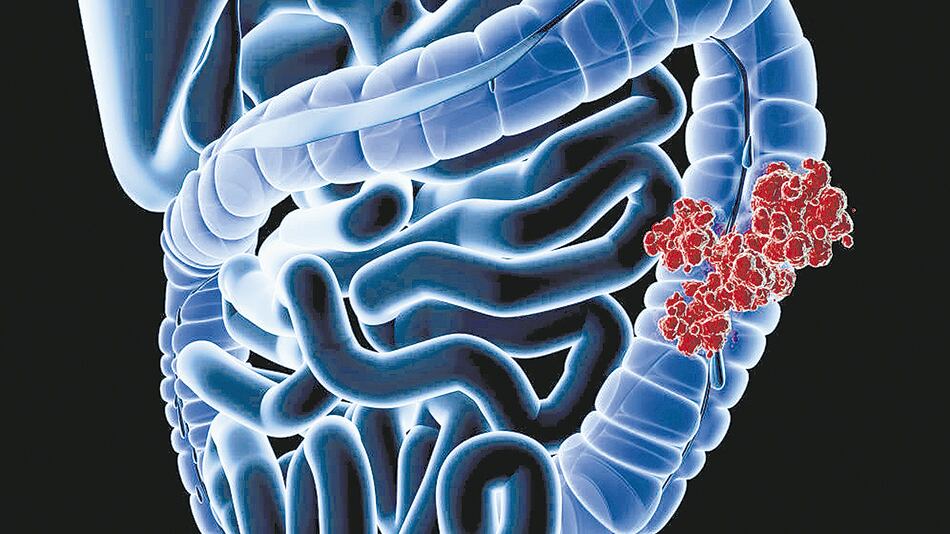 La colonoscopía permite ver el revestimiento interno del colon.