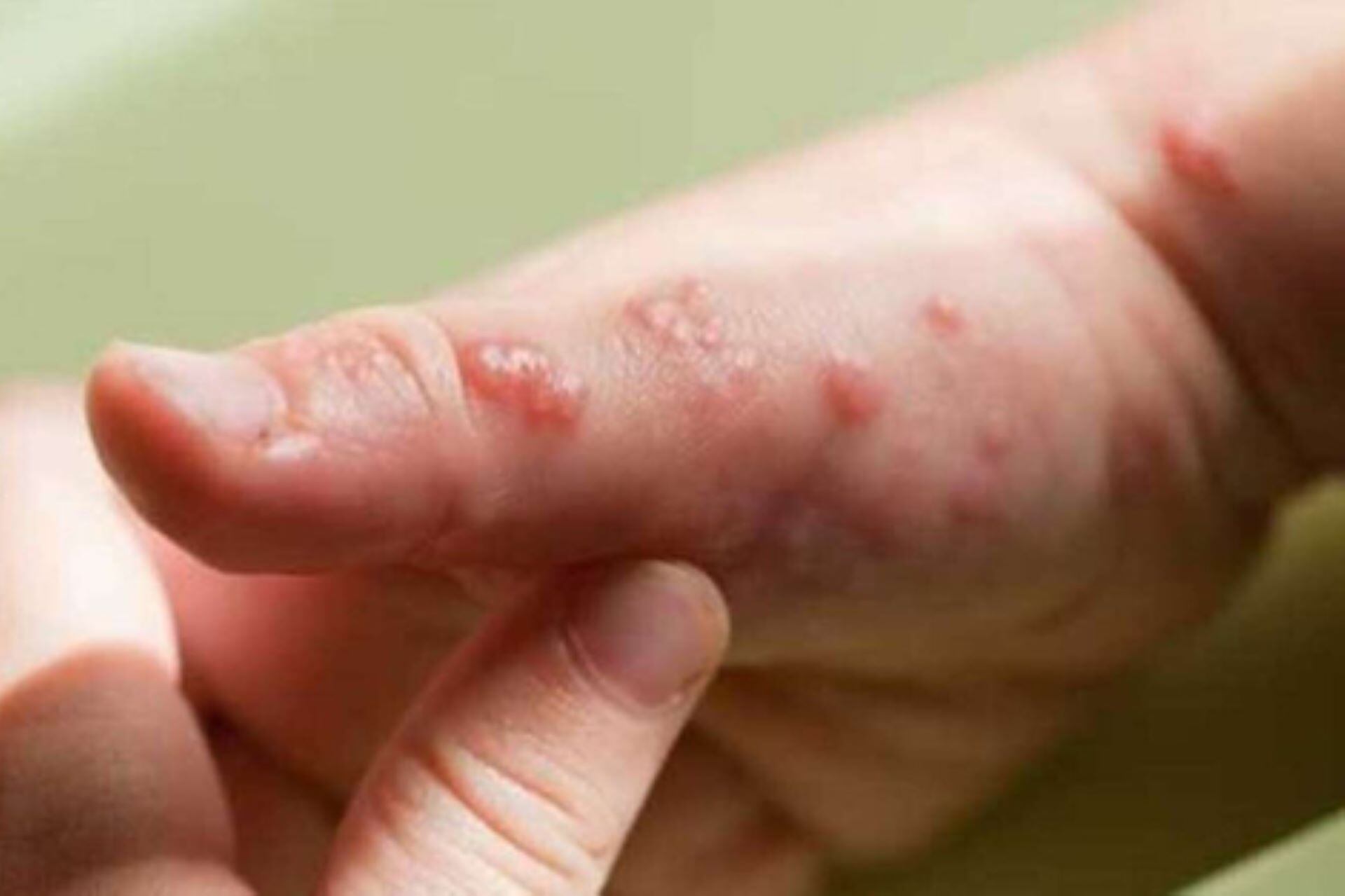 Este lunes, agentes del ministerio de Salud fueron al domicilio de la persona infectada y lo trasladaron al centro asistencial  para que iniciara los 21 días de aislamiento dispuestos por protocolo.