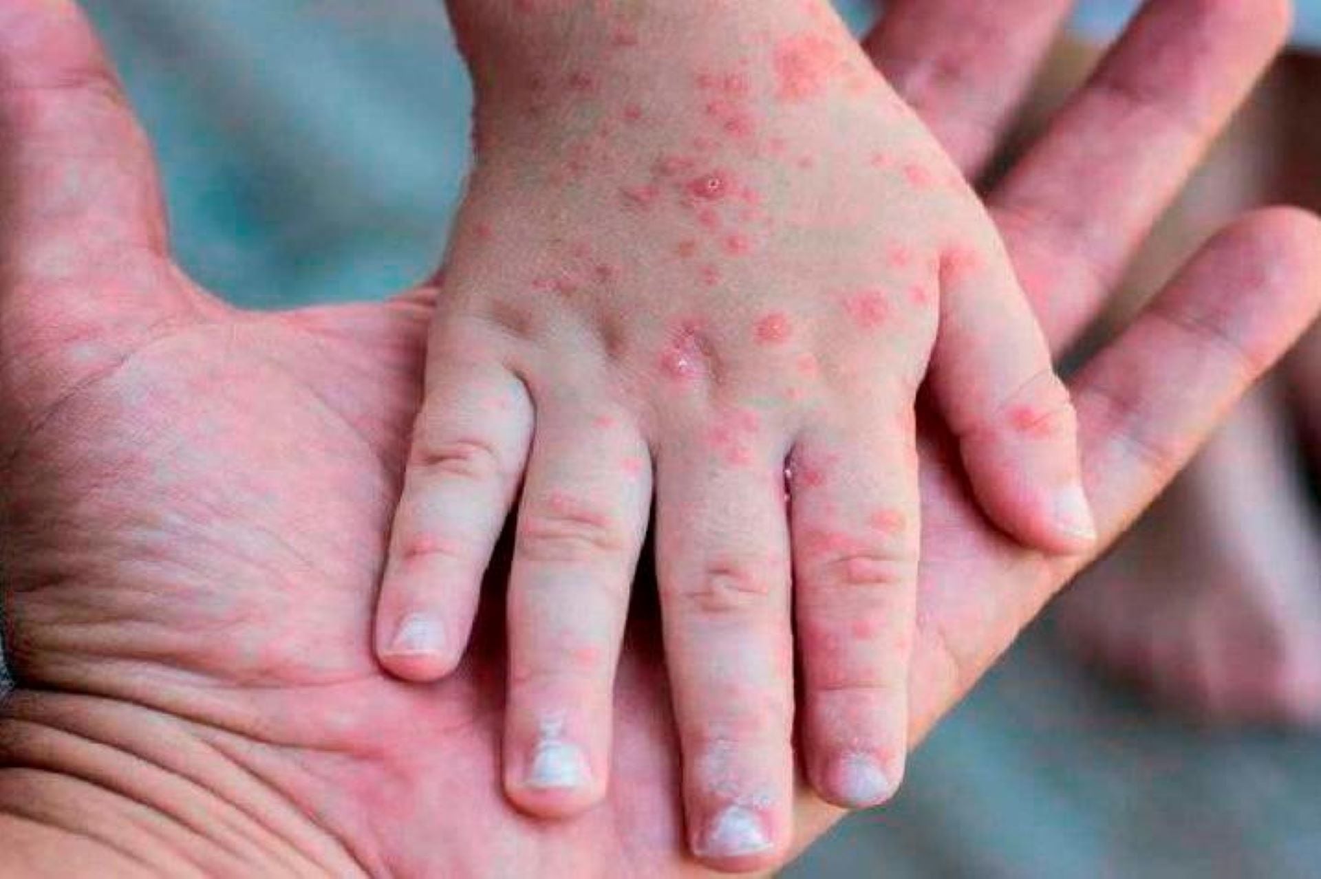 Estados Unidos reportó los dos primeros casos de viruela del mono en menores. (Foto:EFE)