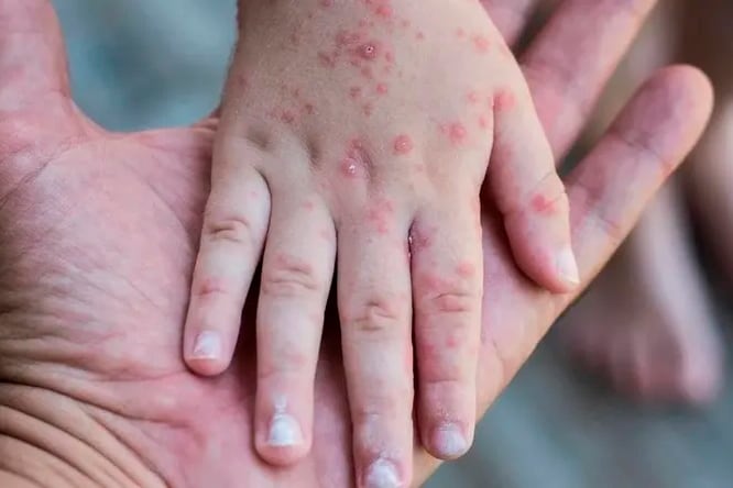 Preocupa que dos de los nuevos casos confirmados en la provincia corresponden a niños que no estaban vacunados contra el sarampión.