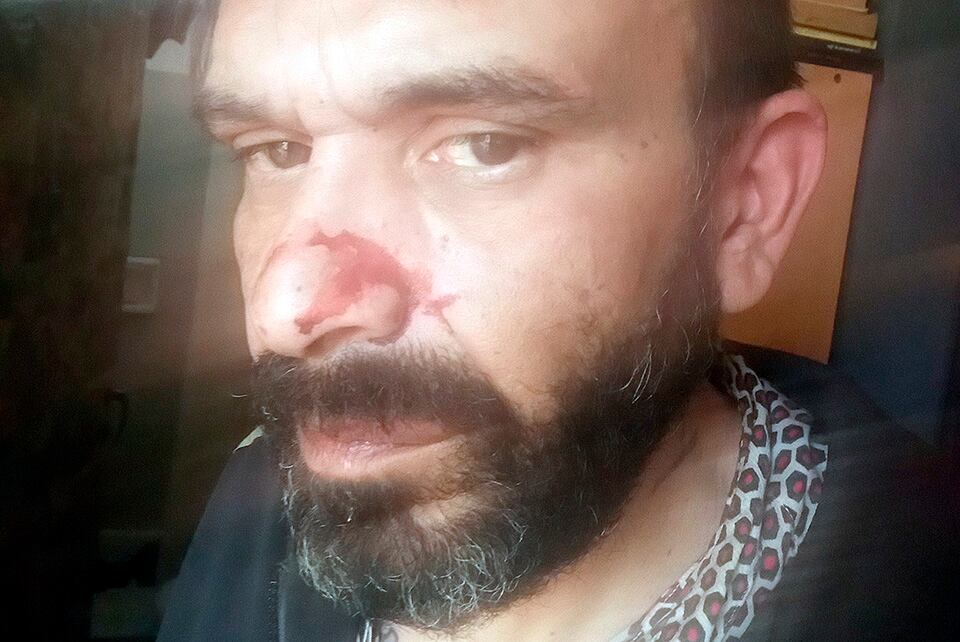 Giacometto mostró lasheridas que le hicieron en fotos de sus redes sociales