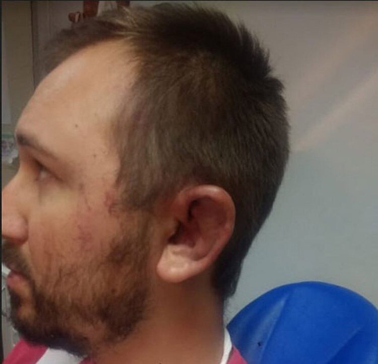 Cararcedo quedó con el maxilar fracturado tras la golpiza.