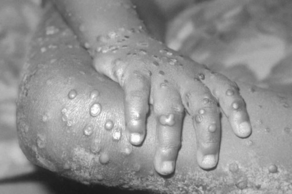 Los especialistas de los Centros de Control y Prevención de Enfermedades de EE.UU. confirmaron el caso. Foto: CDC