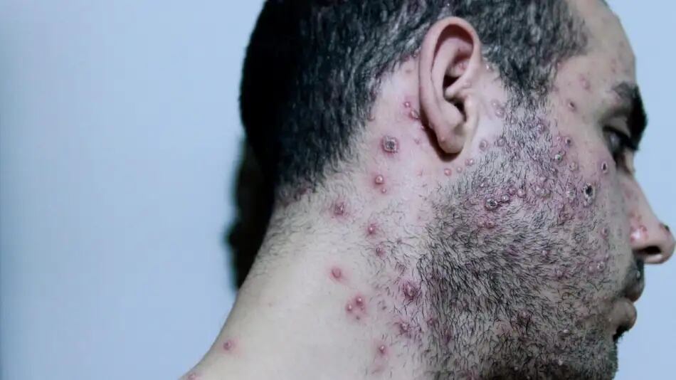 Los exantemas, erupciones en la piel rojiza, 