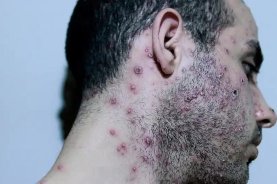 Los exantemas, erupciones en la piel rojiza,