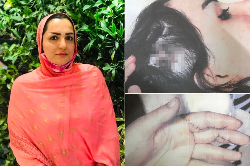 Fariba Akemi y las heridas que le infligió su esposo talibán.