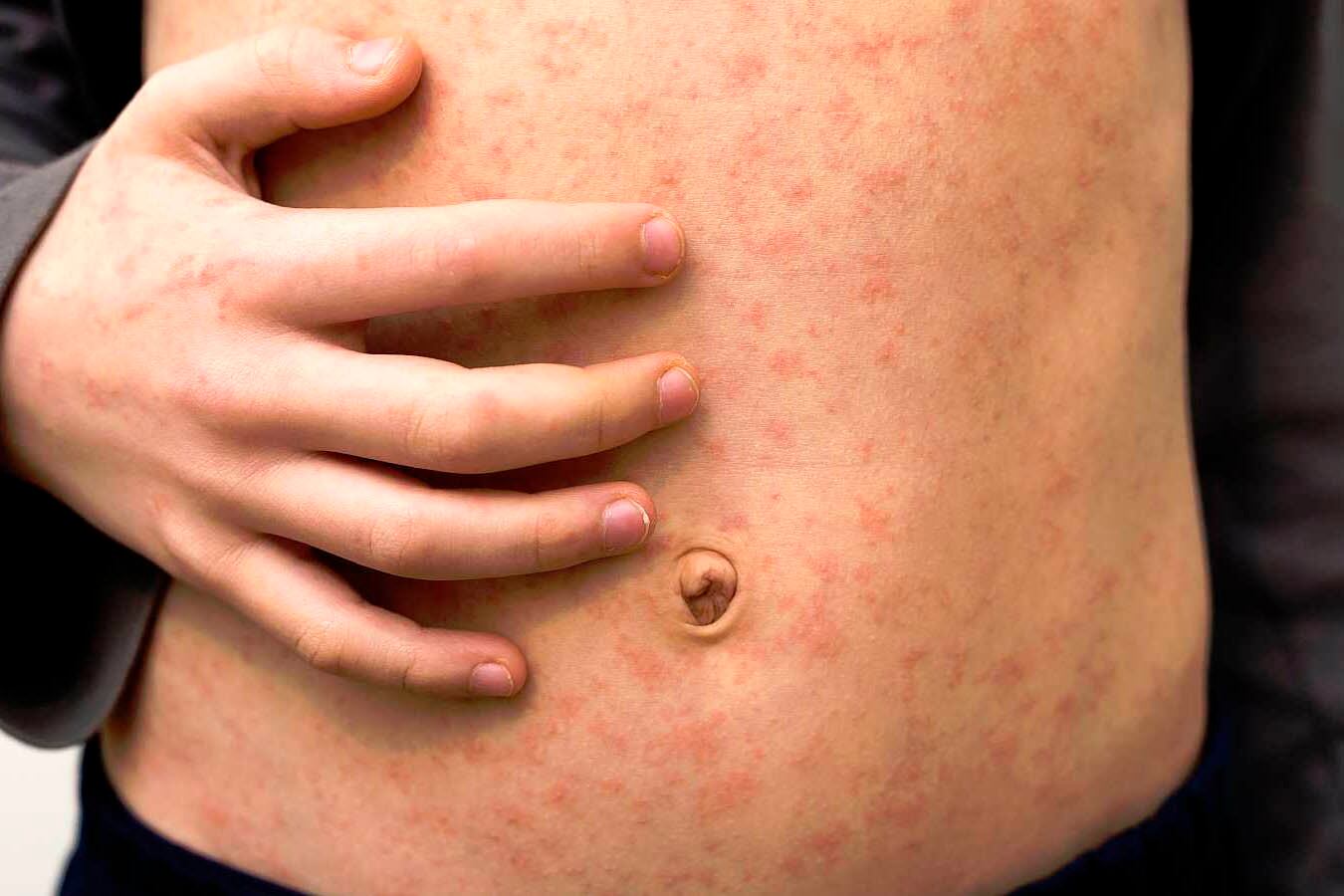 El sarampión volvió con renovada fuerza al país.