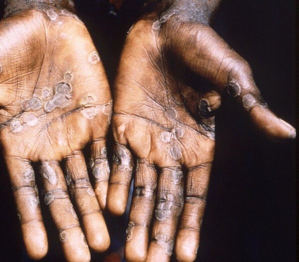 El Gobierno podría confirmar el primer caso confirmado en el país.