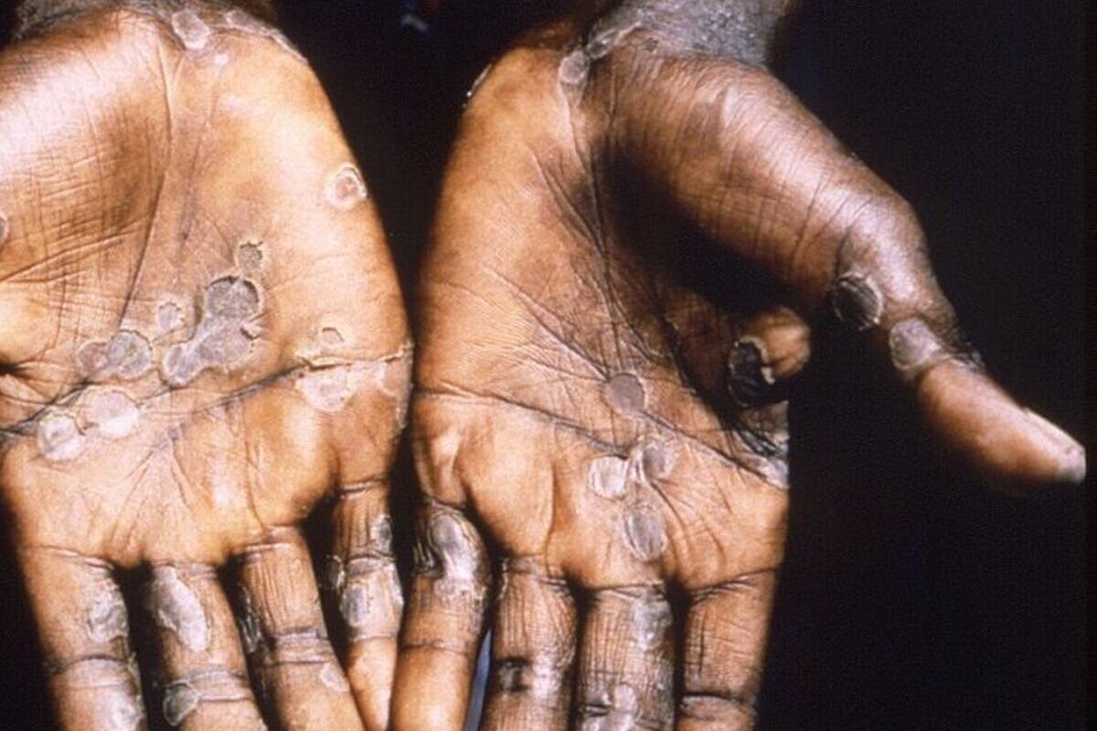 El Gobierno podría confirmar el primer caso confirmado en el país.