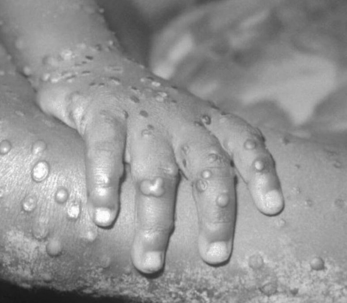 La Agencia de Seguridad Sanitaria del Reino Unido fue la primera autoridad sanitaria de Europa en informar sobre un caso de viruela del mono en un paciente que había viajado desde Nigeria. (Foto: