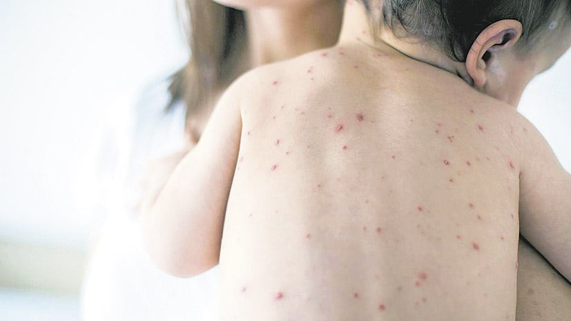 El sarampión es muy contagioso y potencialmente mortal, sobre todo en los bebés que no pueden ser vacunados.