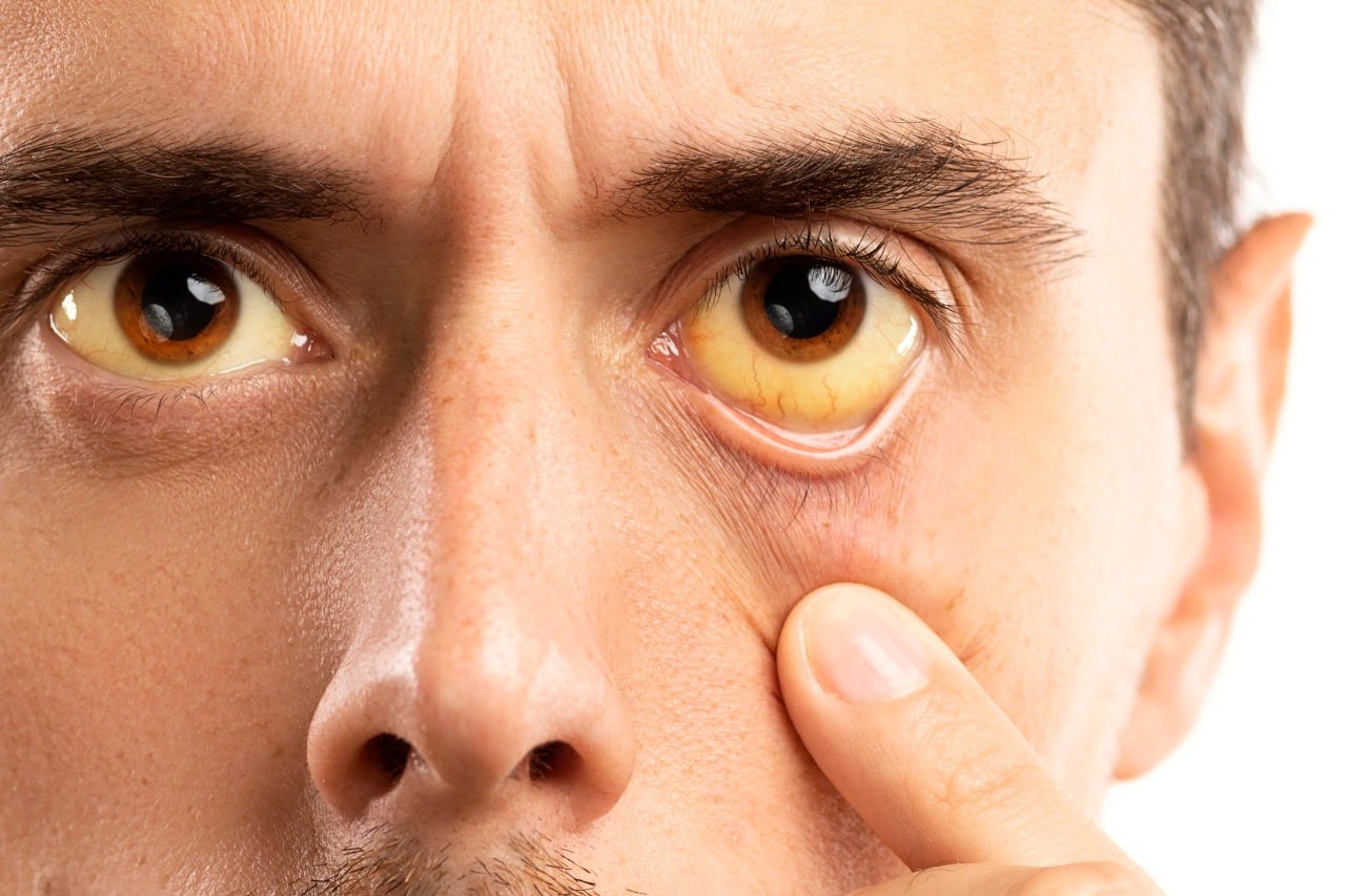 La ictericia es uno de los síntomas de las hepatitis.