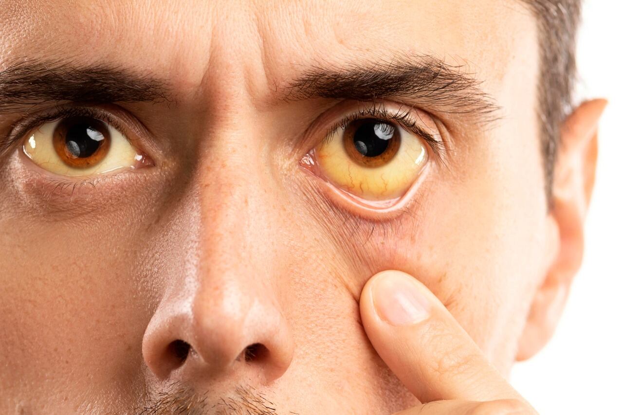 La ictericia es uno de los síntomas de las hepatitis.