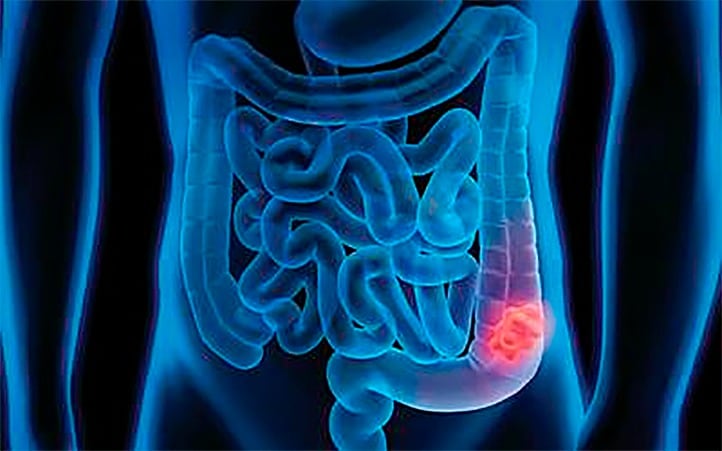 El pólipo se aloja sobre todo en el colon.