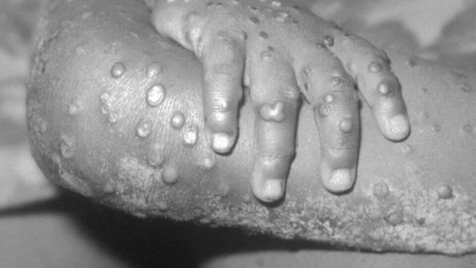 "Es el peor brote fuera de África", explicó Cohen.