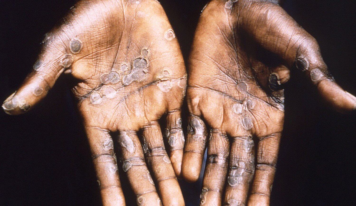 La Organización Mundial de la Salud señaló que la situación preocupa, porque no se consigue contener la propagación de la enfermedad. (Foto: EFE)