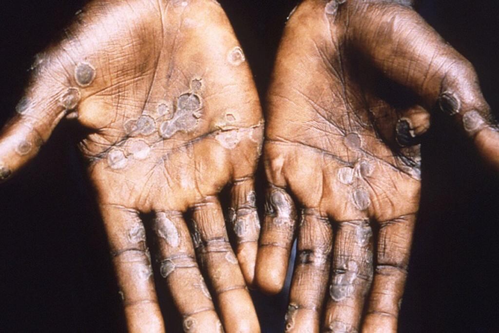 El ministro Jorge López López pidió a la población peruana acudir a los centros de salud si presenta alguno de los síntomas. Foto. EFE.