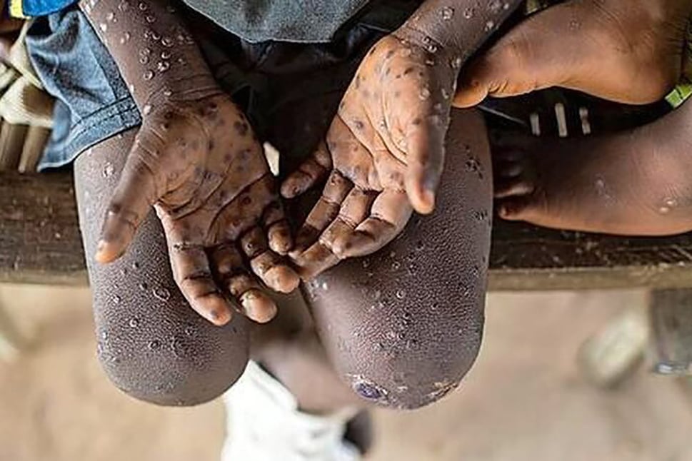 La viruela del mono ya alcanzó a 17 mil personas en 74 países.